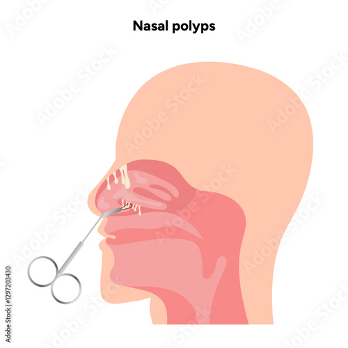 Nasal polyps, nose disease. Diagnostic and treatment. Medical diagram anatomy