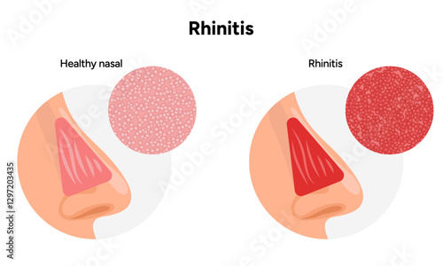 Nose Nasal diseases. Rhinitis symptoms. Allergy, rhinitis, cold medical diagram
