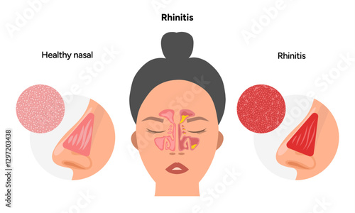 Nose Nasal diseases. Rhinitis symptoms. Allergy, rhinitis, cold medical diagram