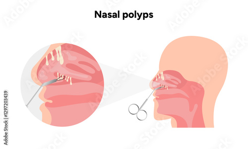 Nasal polyps, nose disease. Diagnostic and treatment. Medical diagram anatomy