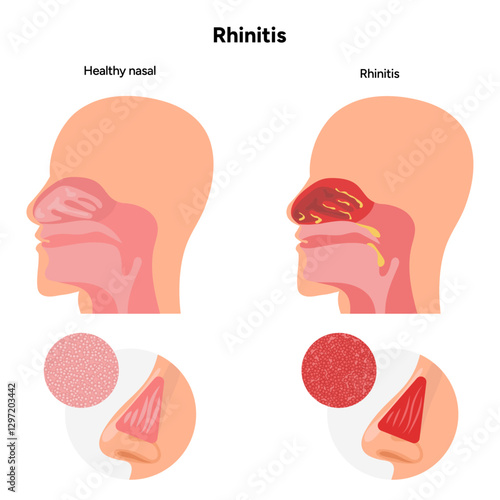 Nose Nasal diseases. Rhinitis symptoms. Allergy, rhinitis, cold medical diagram
