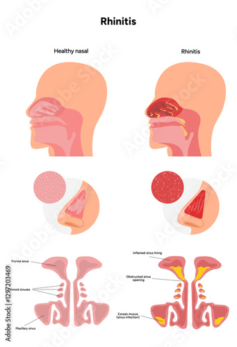 Nose Nasal diseases. Rhinitis symptoms. Allergy, rhinitis, cold medical diagram