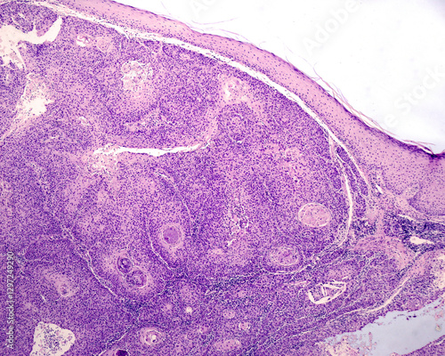Fotografía Human skin. Squamous cell carcinoma