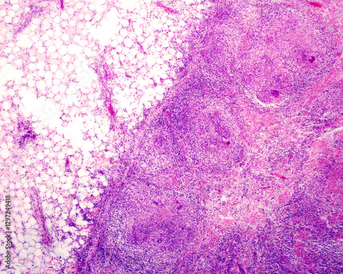 Tableau sur toile Heart pericardium. Tuberculous pericarditis