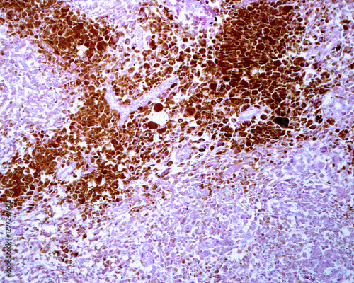 Foto Lymph node. Melanoma metastasis