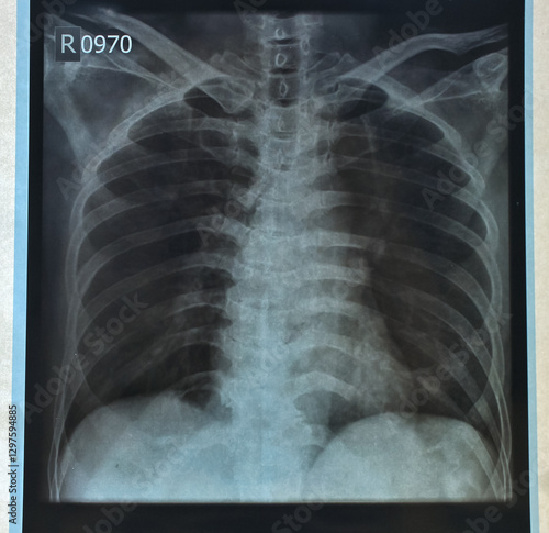 rib bone xray from xray results on human body. Real rib bone xray from hospital. rib bone xray due to impact