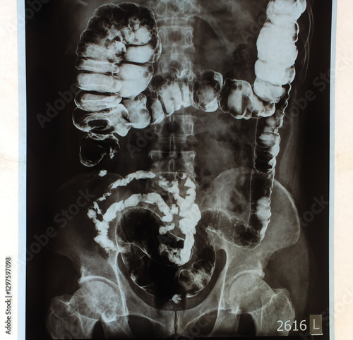 intestines and pelvic bones xray from xray results of pelvic injury. Real intestines and pelvic bones xray from hospital. intestines and pelvic bones xray due to impact