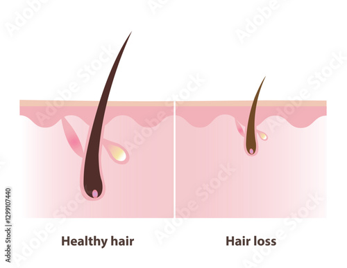 The difference between of hair follicle healthy hair and hair loss with scalp layer illustration. The hair follicle miniaturization leads to the production of thinner, shorter, weaker hair strands.