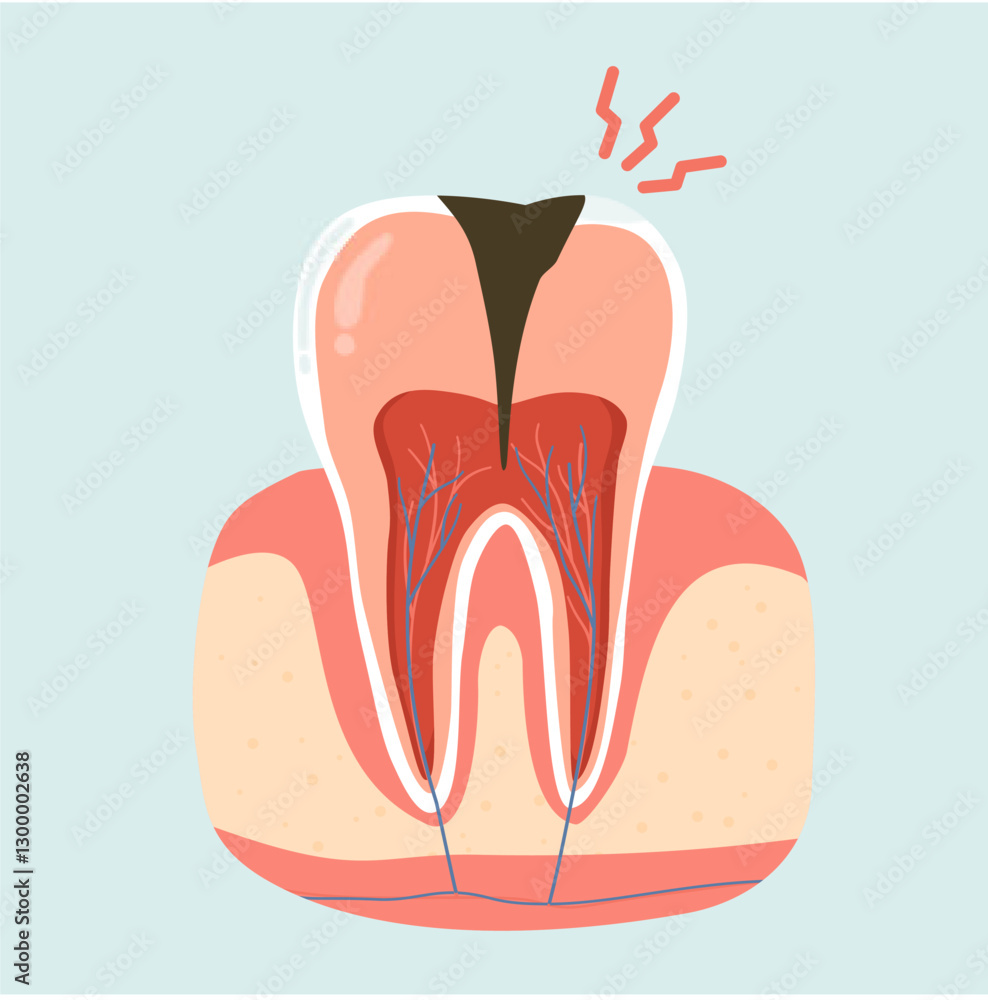 Dental Caries and Decayed Tooth Problem. Dental Care Illustration Dental Caries and Decayed Tooth Problem. Dental Care Illustration