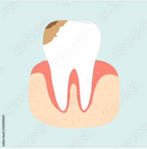 Dental Caries and Decayed Tooth Problem. Dental Care Illustration