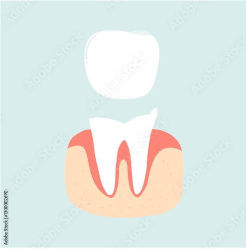 Dental Crown Tooth Illustration. Loss Teeth Solution