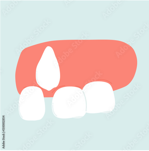 Crowding Malocclusion Teeth Problem. Crooked Teeth Dental Illustration