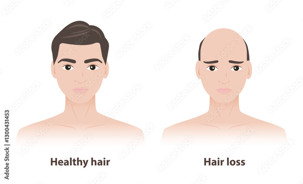 Obraz premium Comparison of two men with healthy hair and hair loss vector illustration on white background. The man with thick and strong hair, the other with thinner hair to baldness, androgenetic alopecia.