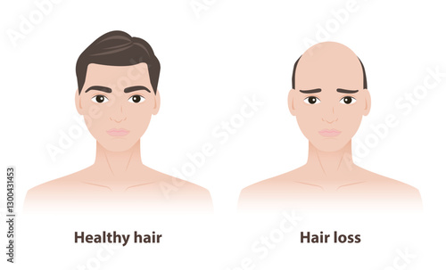 Comparison of two men with healthy hair and hair loss vector illustration on white background. The man with thick and strong hair, the other with thinner hair to baldness, androgenetic alopecia.