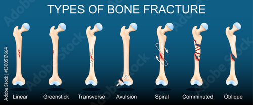 Broken Human femurs on dark background.