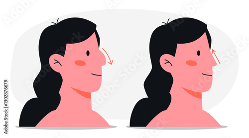 Woman Nose Job Surgery Rhinoplasty Before After.