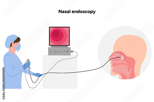 w411Nasal endoscopy procedure nasal and sinus passages. Thin, flexible tube with camera and light with monitor. Ear, nose, and throat doctor otolaryngologist. Medical diagram