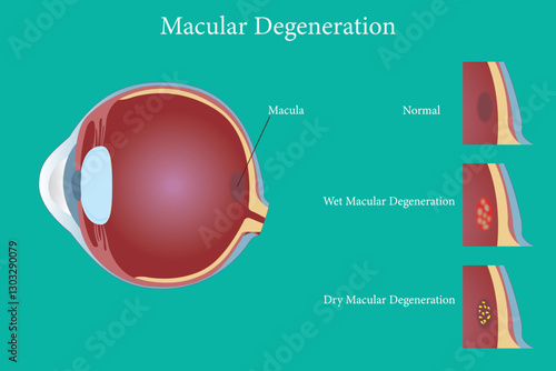 Age-related macular degeneration.Eye vision disorder on green background.