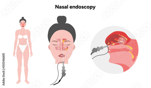 Nasal endoscopy procedure nasal and sinus passages. Thin, flexible tube with camera and light. Ear, nose, and throat. Medical diagram