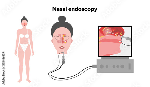 Nasal endoscopy procedure nasal and sinus passages. Thin, flexible tube with camera and light with monitor. Ear, nose, and throat. Medical diagram