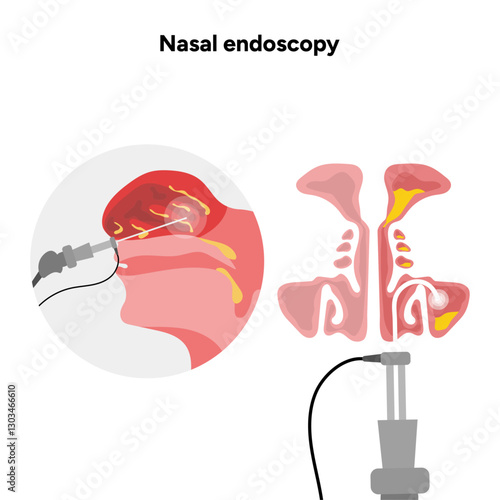 Nasal endoscopy procedure nasal and sinus passages. Thin, flexible tube with camera and light. Ear, nose, and throat. Medical diagram