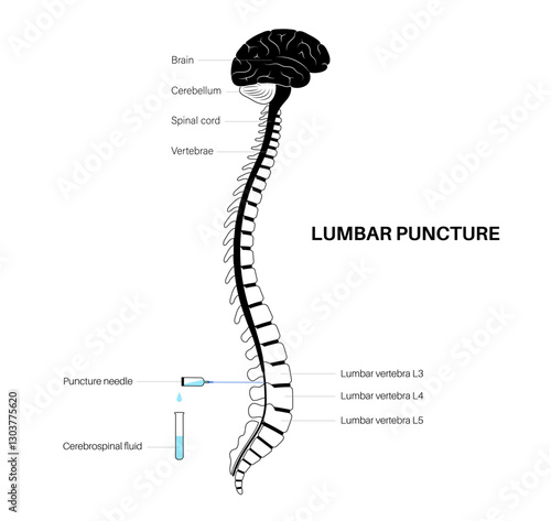Lumbar puncture spinal tap