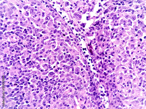 Mixed cellularity classic Hodgkin lymphoma (MCCHL), a subtype of classic Hodgkin lymphoma characterized by Hodgkin, Reed Sternberg cells in a diffuse mixed inflammatory background