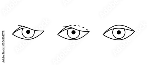 Eyelid correction, blepharoplasty black line icon. Aesthetic plastic surgery of eye. Lift eyelid. Surgical facial rejuvenation. Vector illustration