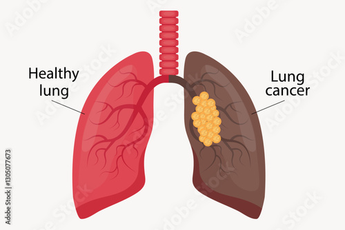 Illustration of healthy lung and lung cancer.