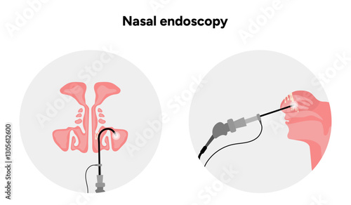 Nasal endoscopy procedure nasal and sinus passages. Thin, flexible tube with camera and light. Medical diagram