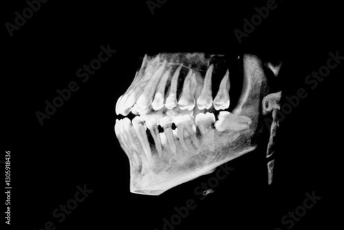 Dental 3d radiograph x-ray lateral view showing an impacted lower wisdom tooth that  failed eruption pressing against the second molar, creating a contact point where a cavity has developed.