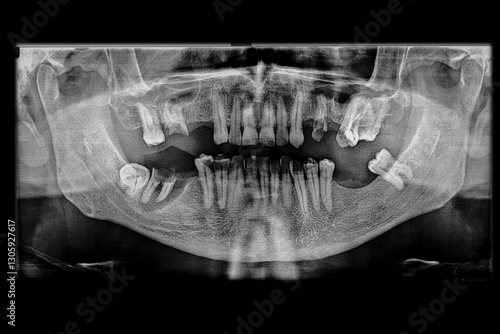 Dental panoramic x-ray revealing multiple cavities, missing teeth, an upper molar with a completed root canal treatment, and an advanced periodontal bone loss affecting an infected lower molar