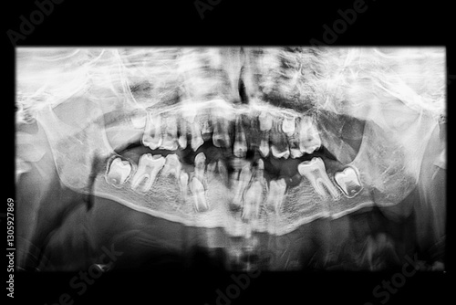 Low-quality dental panoramic x-ray due to movement during the image acquisition of a young patient showing missing teeth, misaligned primary teeth, and permanent teeth included in the alveolar bone