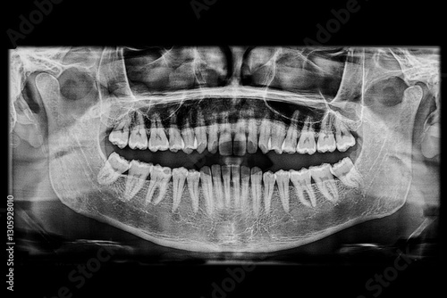 Dental panoramic x-ray of an adult patient showing a clear bone structure of the temporomandibular joint and maxillary sinus with all teeth well-aligned, and a partially decayed first lower molar.