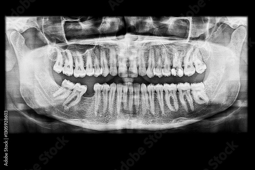 Dental panoramic x-ray of an adult showing a missing lower molar and a mistreated decayed partially filled upper molar. Jaw structure with healthy temporomandibular joints visible in the radiograph.