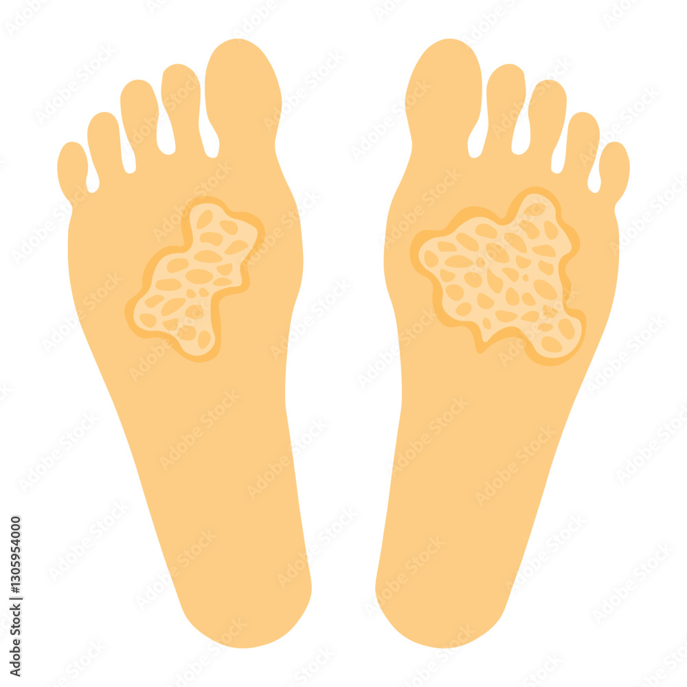 Obraz premium Tinea pedis 