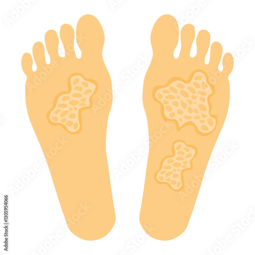 Tinea pedis 