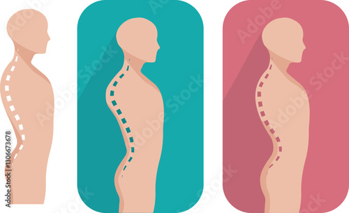 Kyphosis and lordosis are exaggerated natural curves in the spine 