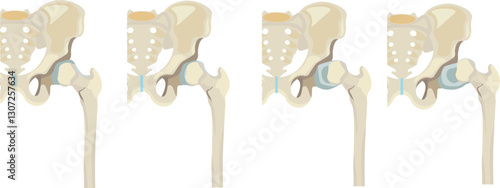 hartofilakidis classification is criteria to describe three types of developmental hip dysplasia
