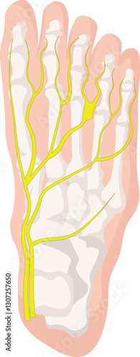 thickening of the tissue that surrounds the digital nerve leading to the toes known as morton neuroma 