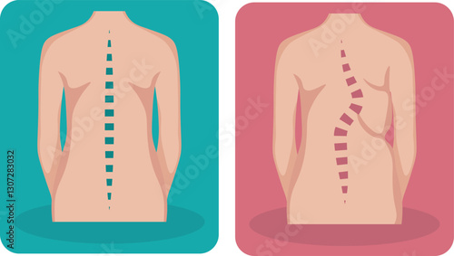 Scoliosis where there sideways curvature of the spine that is commonly diagnosed in adolescents