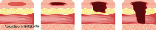 Pressure ulcers formation on bony parts of the body, such as the heels, elbows, hips and tailbone