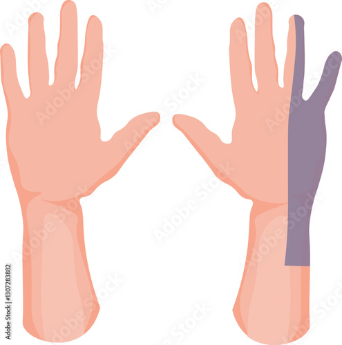 Wartenberg's Sign where there is slightly greater abduction of the fifth digit, due to weakness or paralysis of the adducting palmar interosseous muscle