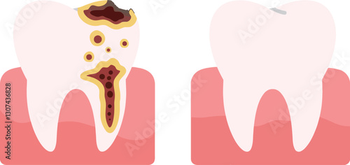 Tooth illustration showcasing dental decay on one side and a healthy tooth on the other side in minimalist vector art