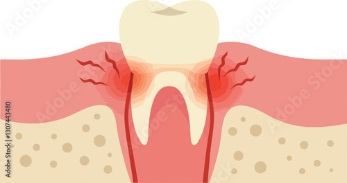 Tooth with inflamed gums depicted in flat style showcasing dental issues in a clean, minimalist vector illustration