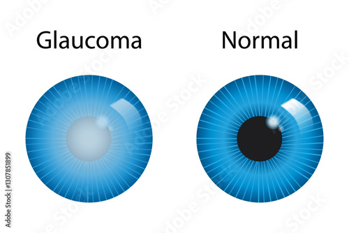 Glaucoma surgery concept. Procedures to reduce intraocular pressure to prevent vision loss. Human eye anatomy poster