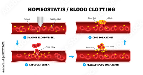 Homeostasis of blood clotting progress diagram, medical illustration, Hemophilia wound healing injury bleeding, labeled damage blood vessel, vascular spasm, platelet plug formation, clot formation.