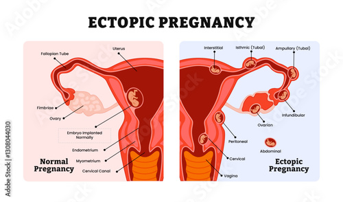 Ectopic Pregnancy or Tubal and Normal pregnancy medical diagram, labeled female reproductive system structure, embryo attachment locations, gynecological medical science educational.