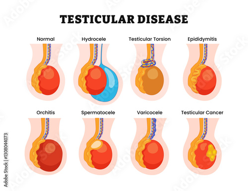 Different types of testicular disease, male anatomy medical inflammation, labeled testicular cancer, torsion, hydrocele, epididymitis, orchitis, spermatocele, varicocele. Vector illustration.