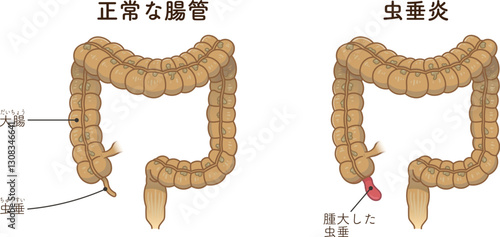 虫垂炎のイラスト appendiciti illustration